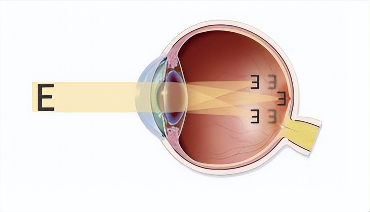 左右眼睛散光差距100度应如何治疗,超高度散光的治疗方法