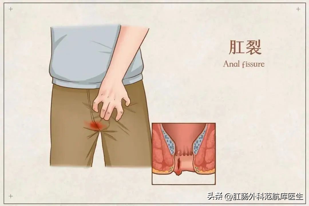 外伤会导致肛周脓肿吗,肛裂一定是受到外伤吗