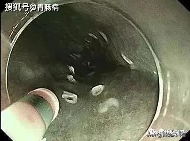 嗓子干痒、有异物感...当成咽炎，差点要命