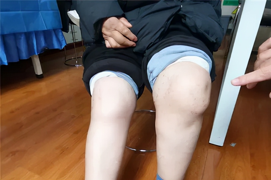 类风湿患者自述疼痛过程,如何减轻类风湿疼痛