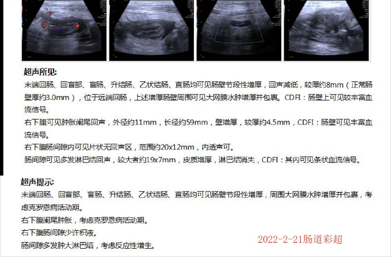 回肠克罗恩病可用阿达木治疗吗,克罗恩有肠瘘怎么动手术