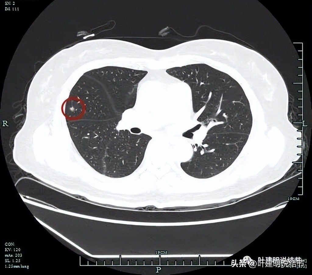 肺癌右中上叶全切,右肺上叶小结节查出是癌怎么办