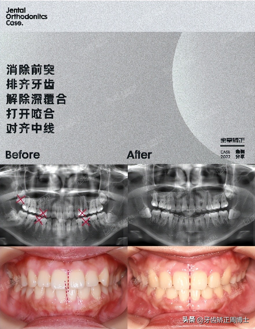 低角面型下巴前倾正畸案例,露龈笑嘴凸下巴后缩