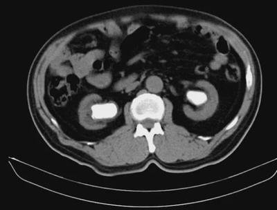 肾囊肿多大对身体造成严重影响,关于肾囊肿大小及处理方法