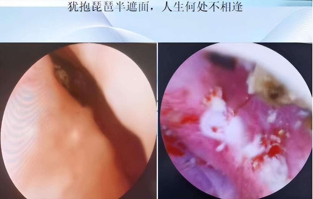 明知山有虎,偏向虎山行——肾斗士VS肾结石