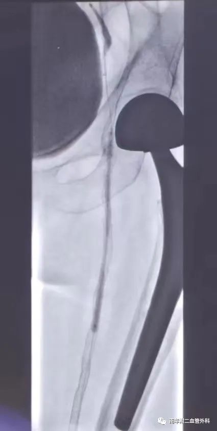 下肢血管闭塞介入治疗视频,动脉血管狭窄的最新介入治疗方法