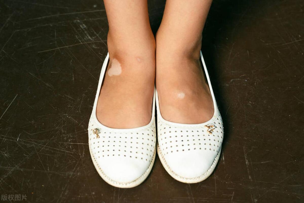 面部白癜风用他克莫司软膏哪种好,面部白癜风308光疗哪些反应是好转