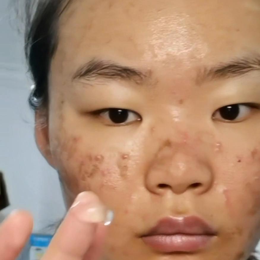 点阵激光后日常护理,点阵激光术后喷雾推荐