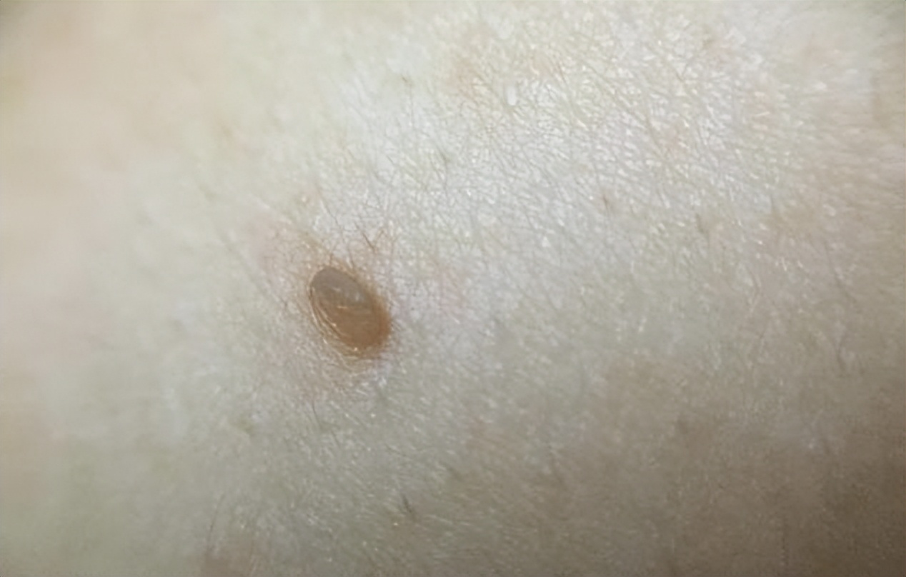 脖子上长小肉粒被自己揪掉了,脖子上的小肉粒揪掉后会怎样