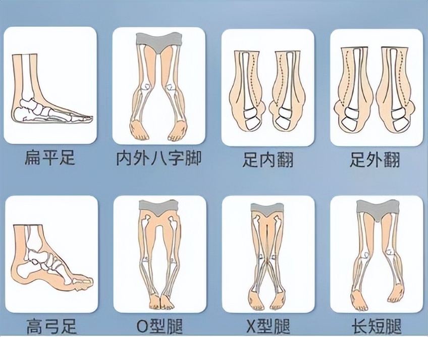 足弓平是什么意思,扁平足弓为什么容易受伤