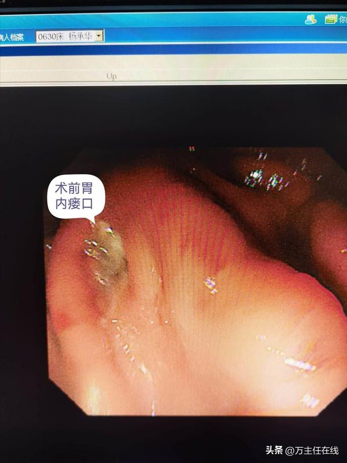 腹腔粘液癌治疗有妙招——万荣教授以内镜Notes技术成功胃减压