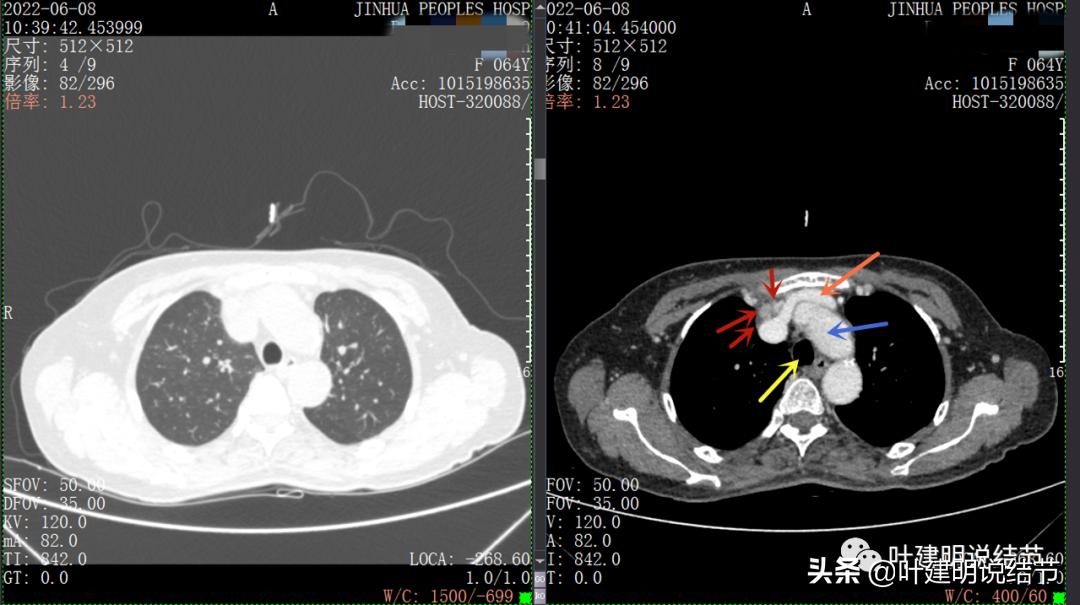 这位老乡，乏力来查，查出这么大个的纵隔肿瘤！会是什么呢？