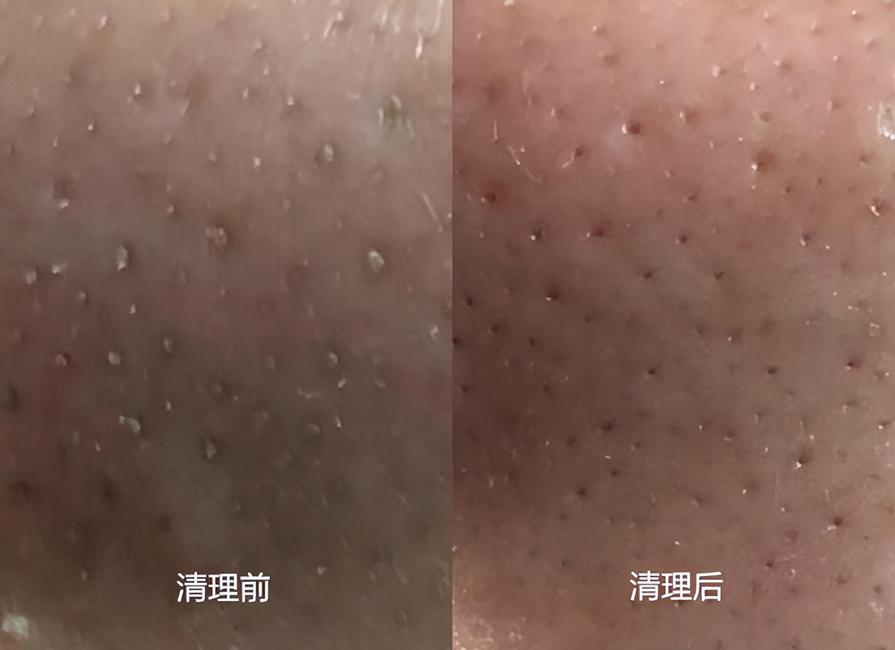 挤鼻子上的黑头和粉刺,鼻子上的粉刺该不该挤