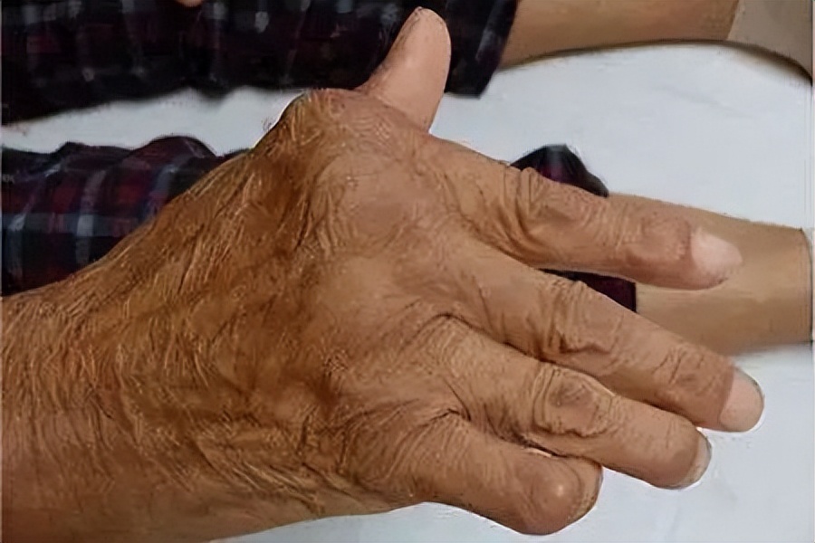 类风湿关节炎活动期饮食注意哪些,类风湿性关节炎的护理措施