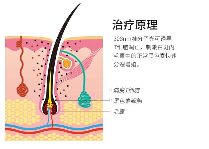 308光疗仪对白癜风治疗有效果吗,308紫外线灯治疗白癜风效果图