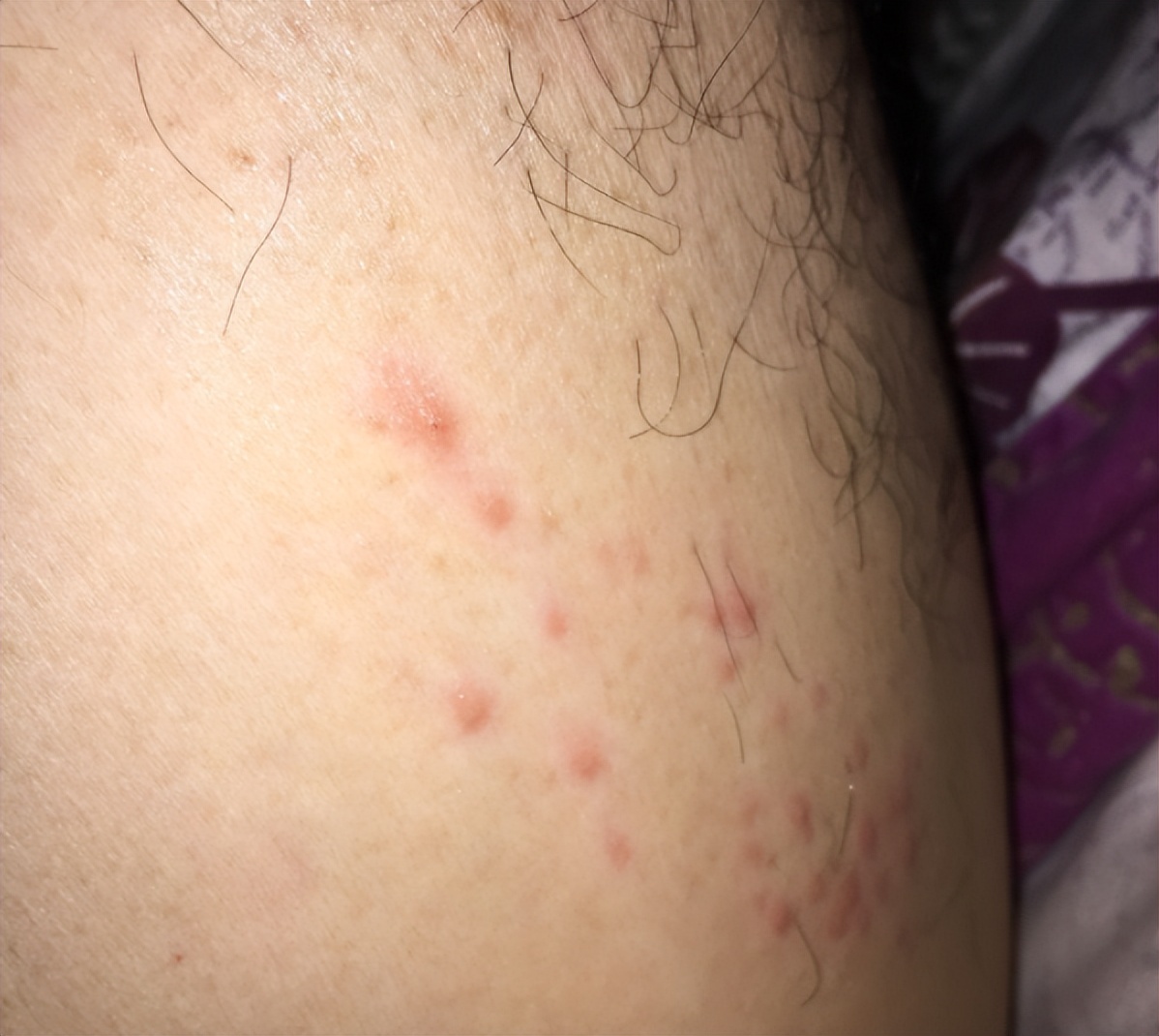 腋窝长了硬块是艾滋病吗,腋下有肿块有可能是艾滋病吗