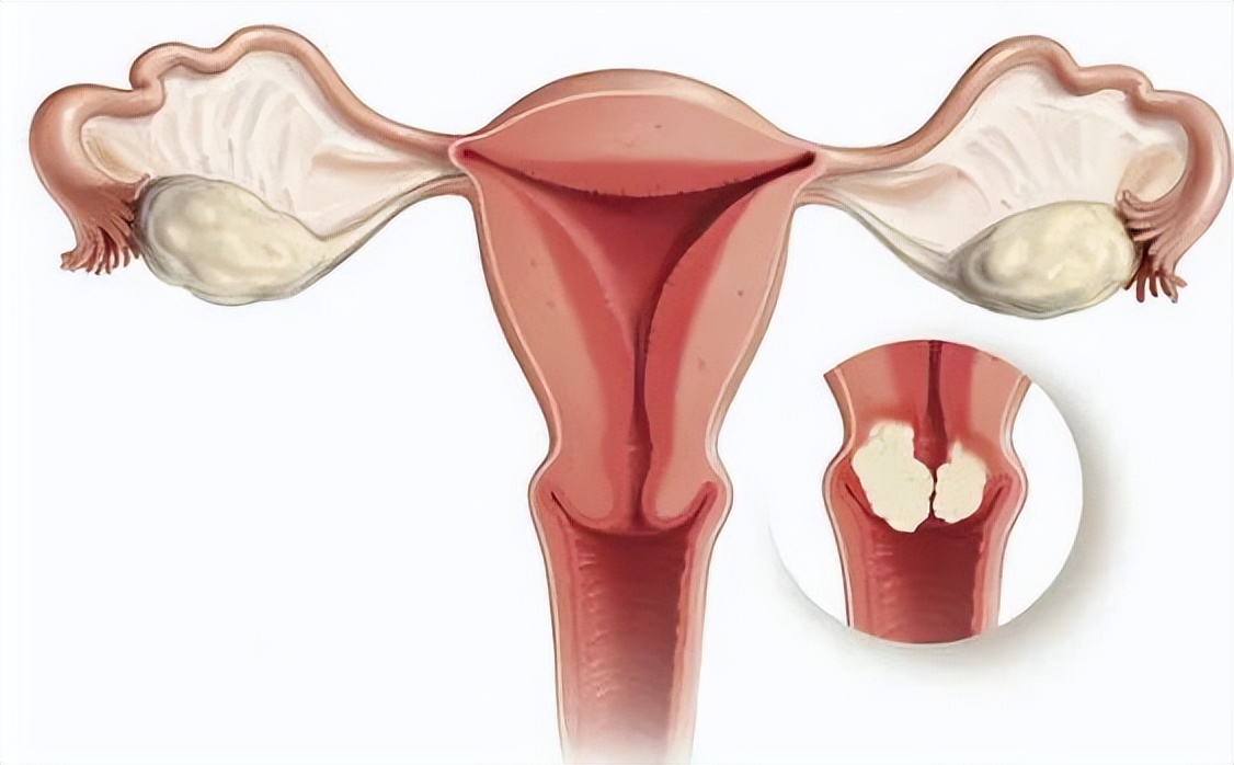 宫颈尖锐性湿疣怎么治疗好,宫颈尖锐性湿疣最佳治疗方法