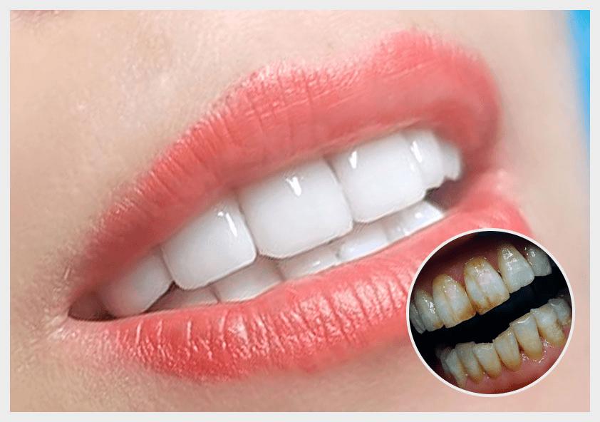 氟斑牙是刷牙引起来的吗,氟斑牙可以洗下去吗