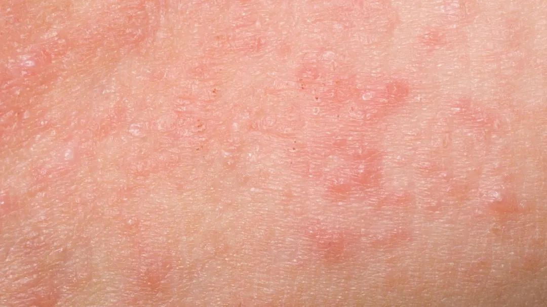 过敏反反复复吃药也没用怎么办,过敏体质反反复复的过敏该怎么办