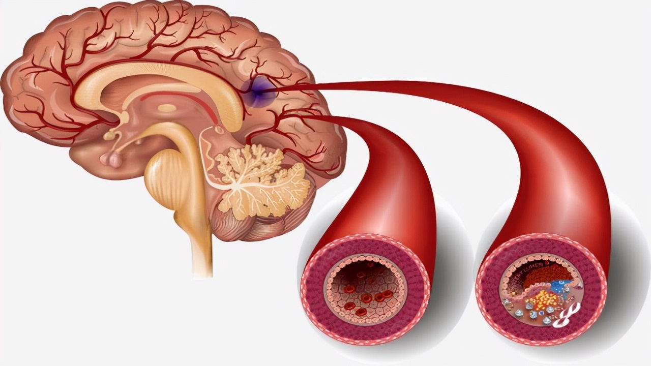 阿司匹林和阿托伐他汀要长期吃吗,阿司匹林和阿托伐他汀吃多久有效