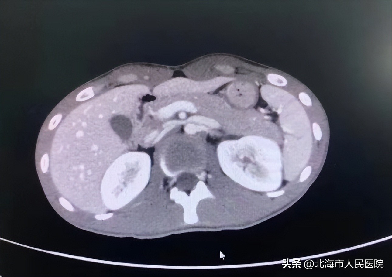 男子骑摩托翻车致大腿骨折,男子骑摩托摔骨折