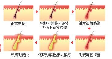 毛囊炎和湿疹的区别,毛囊炎是疮的范畴吗