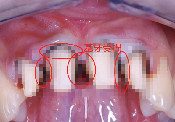 烤瓷牙什么情况要拆除,烤瓷牙崩瓷了要修复多少钱