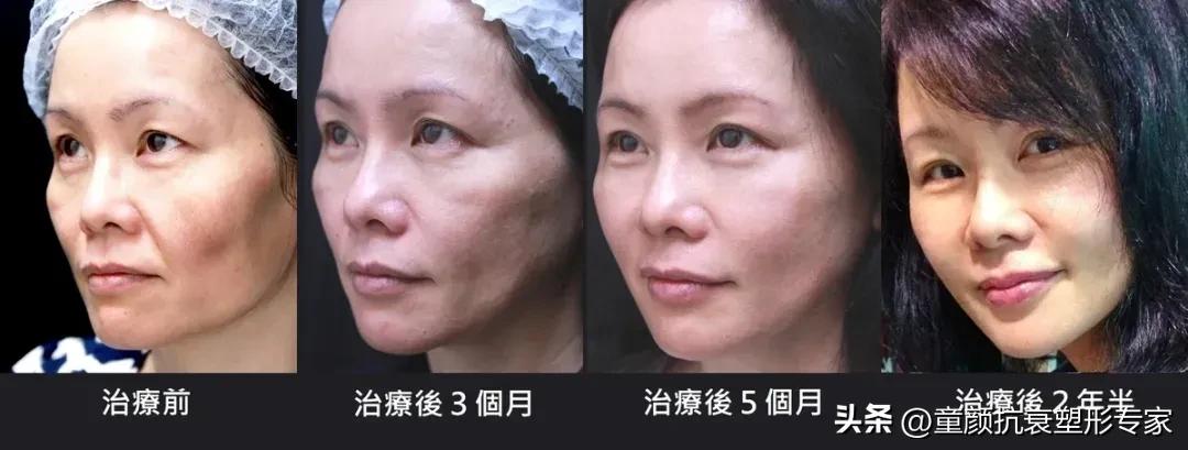 微整注射材质的选择：少女针，童颜针or儒白天使？