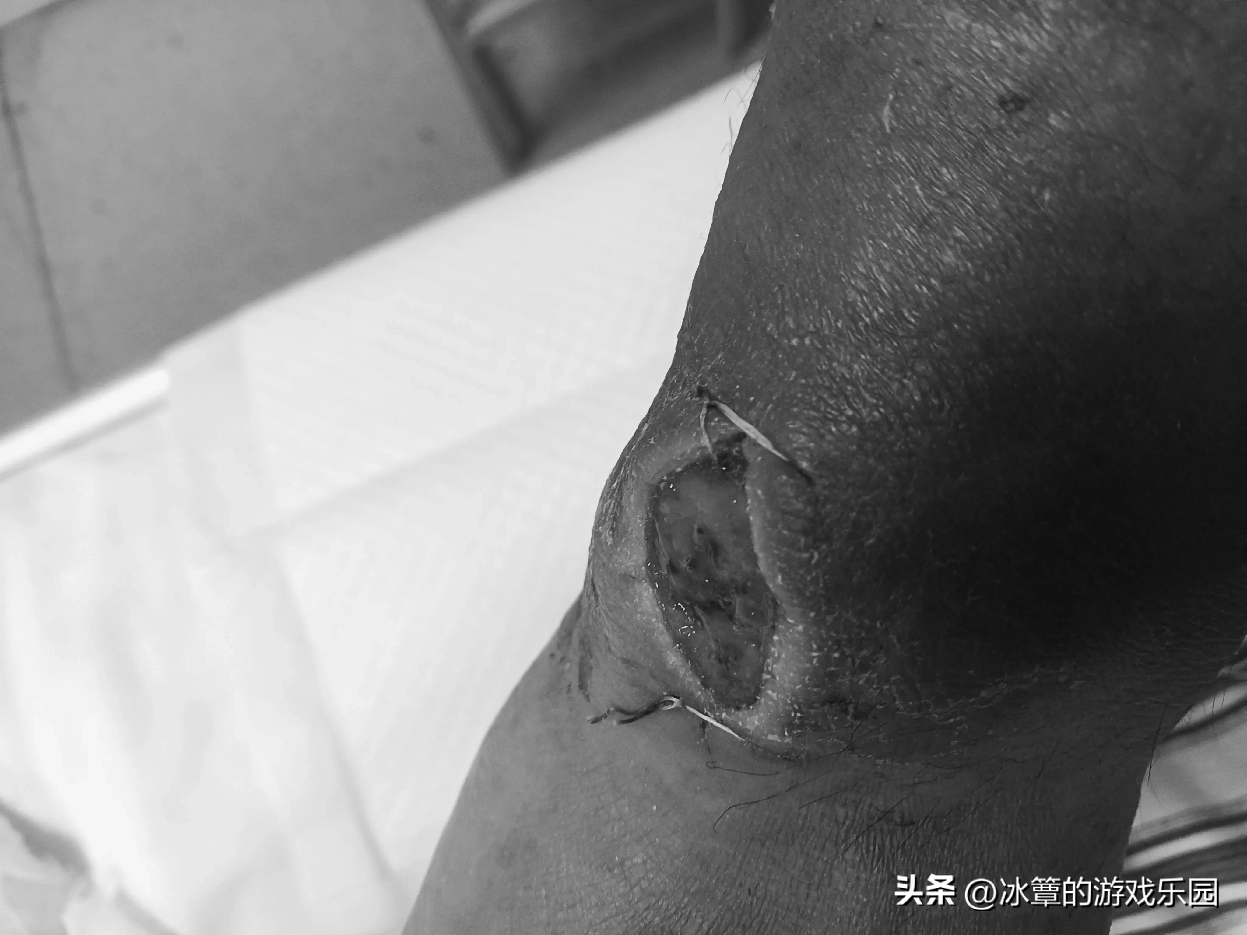 出院拔针,再次住院要相隔多少天才能报销