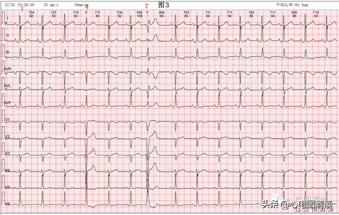 窦性心律偶见室性融合波,室性并行性心律