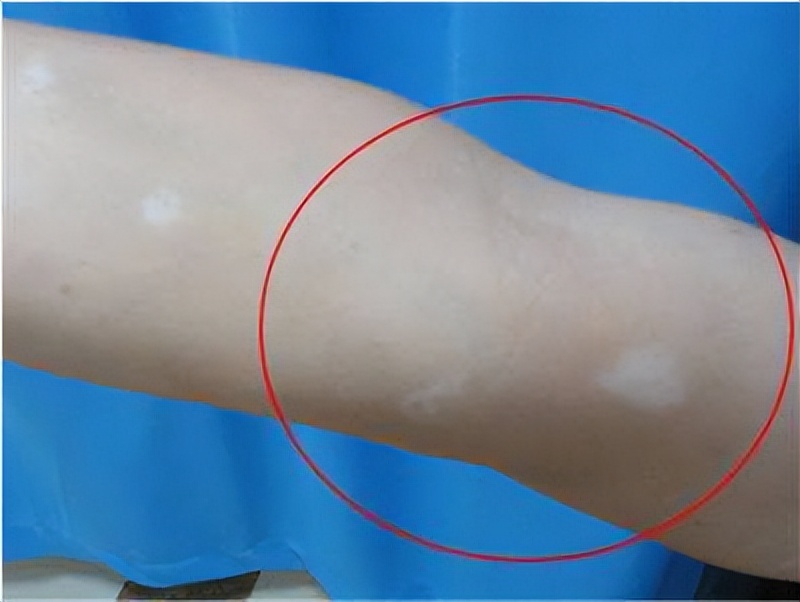 孩子脸上长白斑是怎么回事？是白癜风吗？要让娃吃“打虫药”吗？