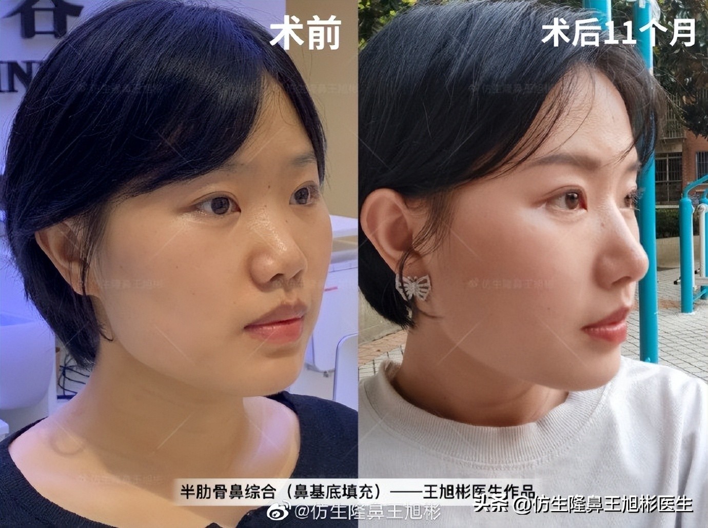 鼻基底填充会移位到鼻孔吗,鼻基底填充假体会拉长人中吗