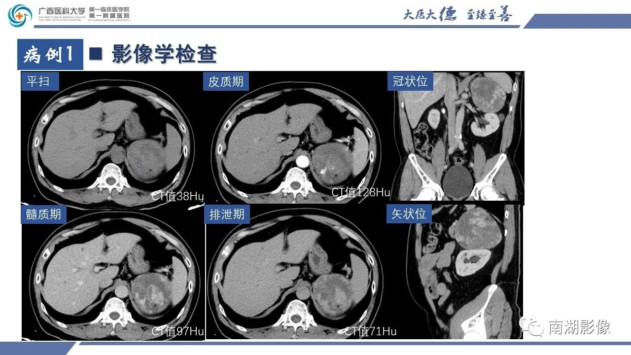 肾上腺海绵状血管瘤,肾上腺血管瘤是良性还是恶性