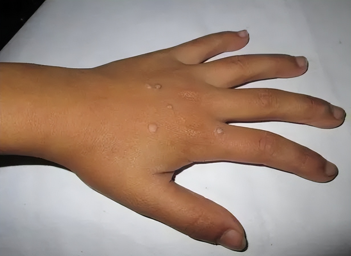 脖子上有包块是怎么回事,脖子上的丝状疣怎么去除