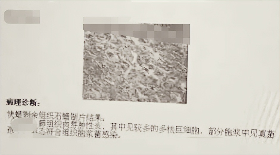 肺结节进一步检查排除肿瘤,肺结节4mm报告建议复查