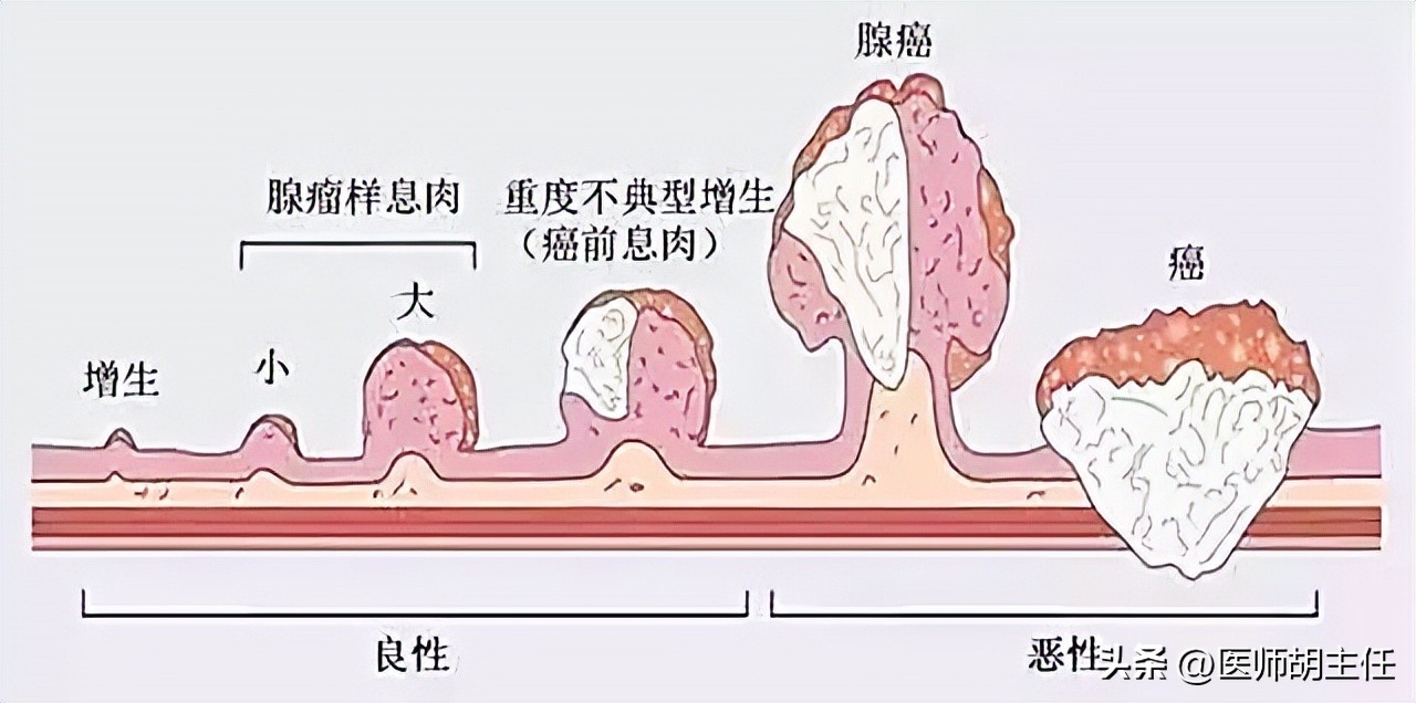 长肠息肉以后会得肠癌吗,肠息肉会癌变成肠癌吗