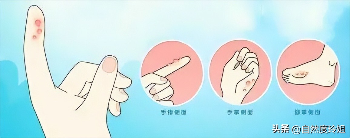 手脚突然起小水泡很痒怎么办,手脚一到夏天就起水泡