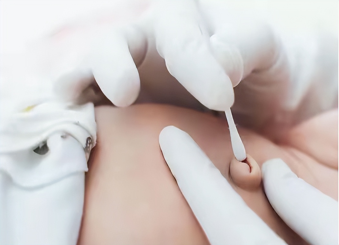 肚脐里的泥是什么能不能抠掉,肚脐眼里的黑泥是什么东西