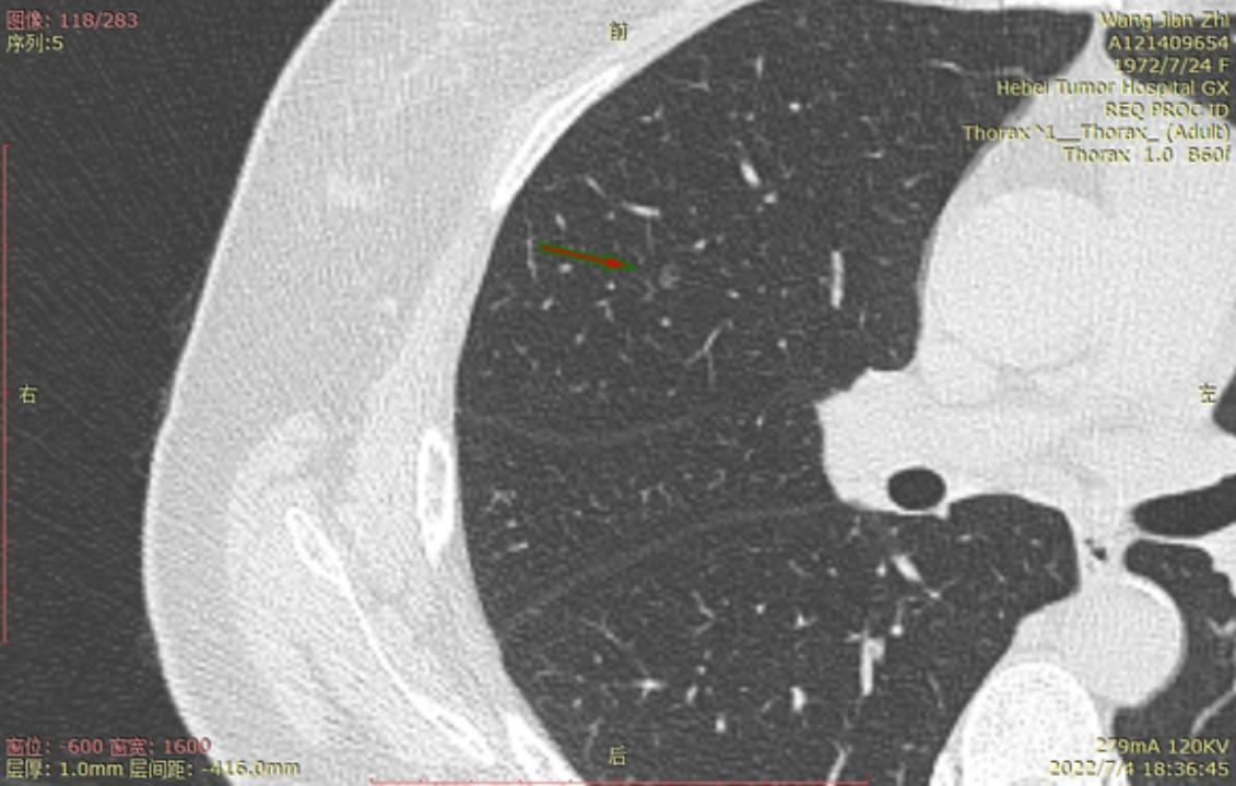 首次发现磨玻璃结节要吃药消炎吗,磨玻璃结节警惕合并占位