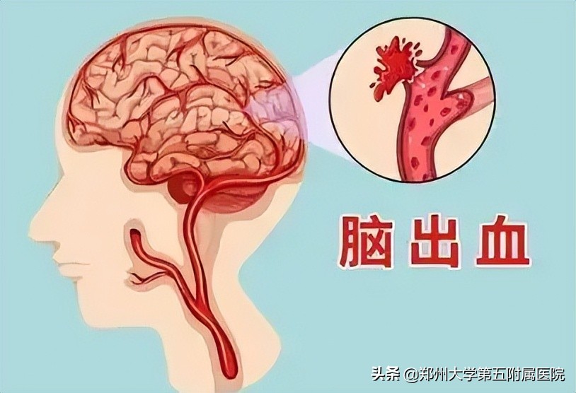 脑出血后遗症如何康复最快呢视频,脑出血的康复治疗的有关视频