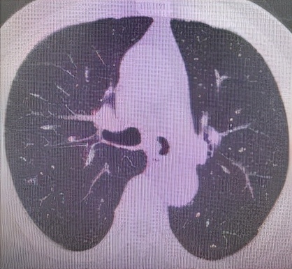 哈医大一院气管镜,哈医大群力呼吸内科