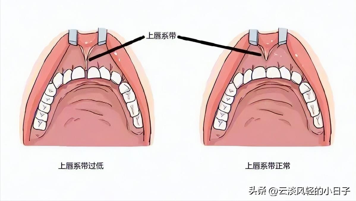 小孩在幼儿园摔断了唇系带,这个伤口好尴尬!