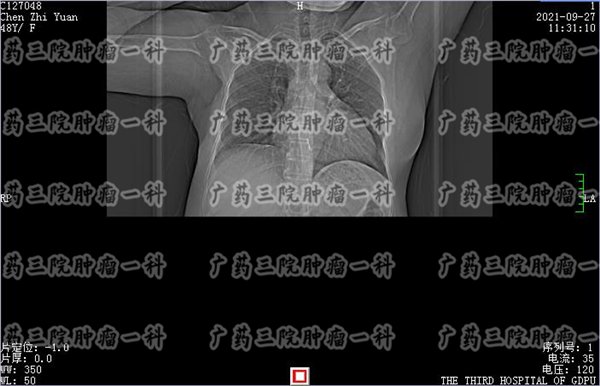 乳房胀痛不适，广药三院彭齐荣教授提醒可能是乳腺癌的症状