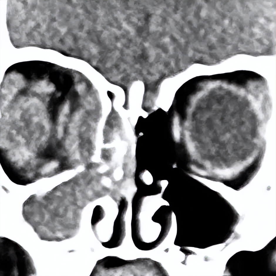 三岁女童被感染,三岁女孩感染病毒