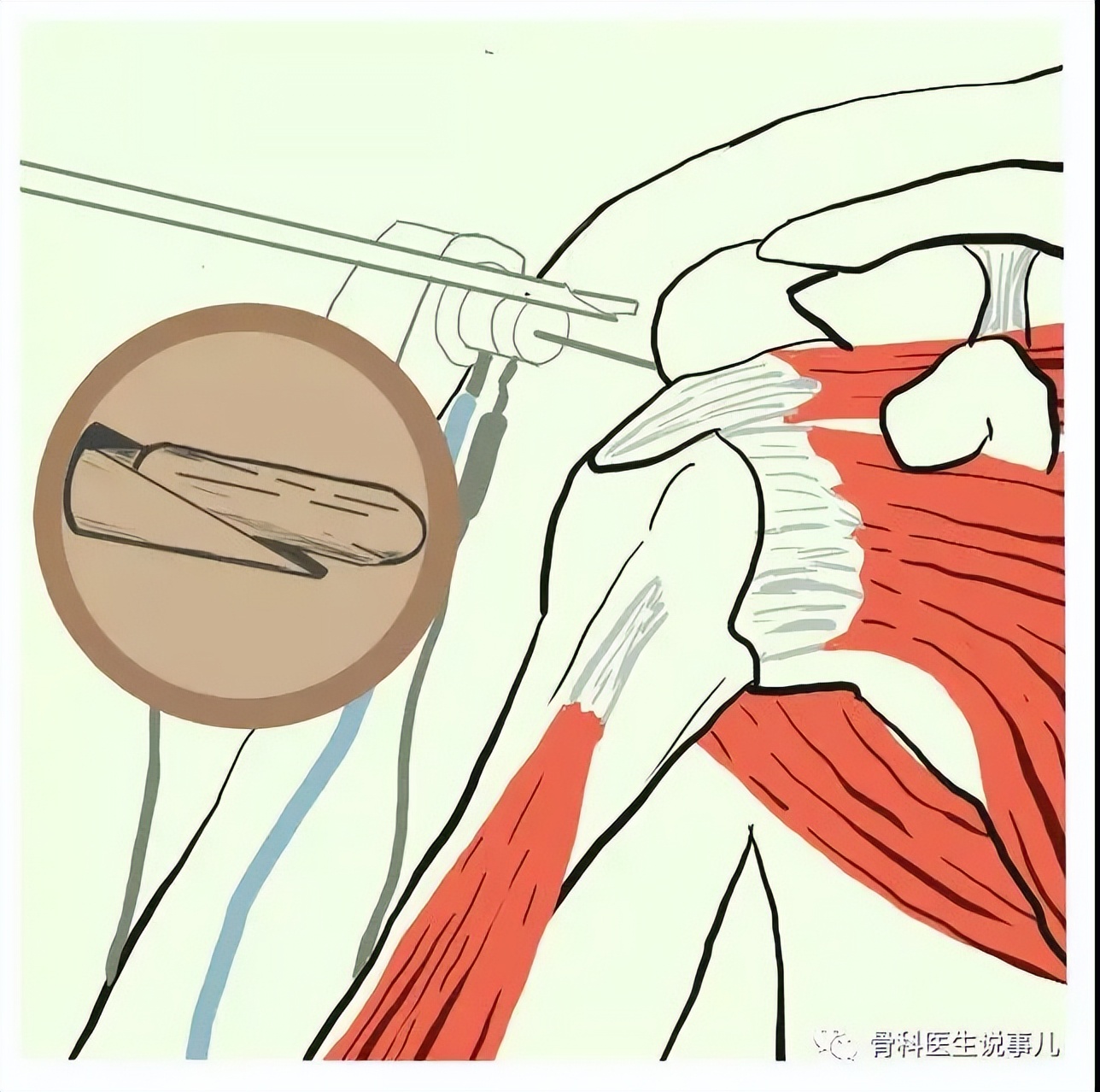 手臂抬举就酸胀是什么原因,手臂抬举肩膀就痛是什么原因