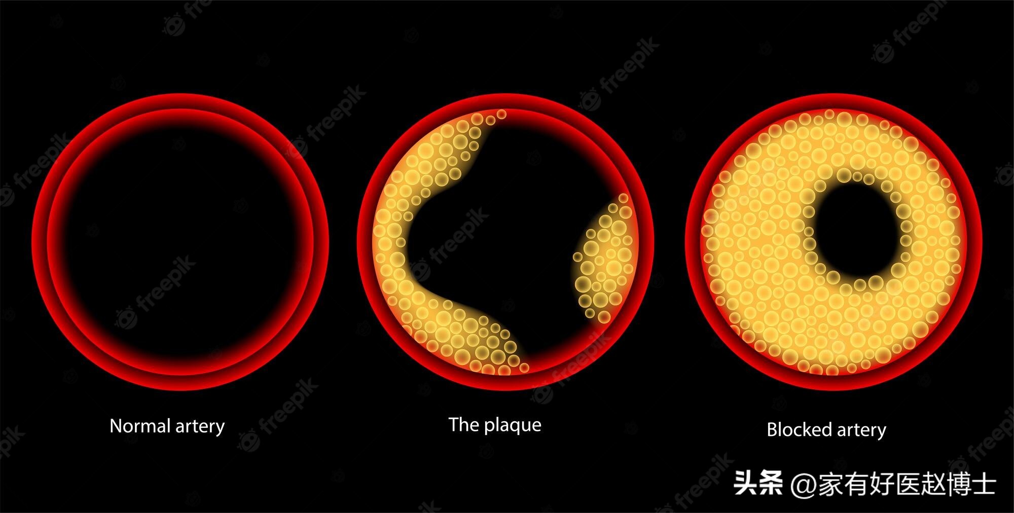 超声颈动脉可以查出什么原因,超声颈动脉斑块的危险评估