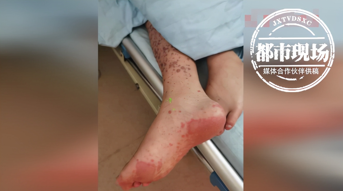 青少年身上有刺痛感像针扎,皮肤针扎般疼痛怎么治