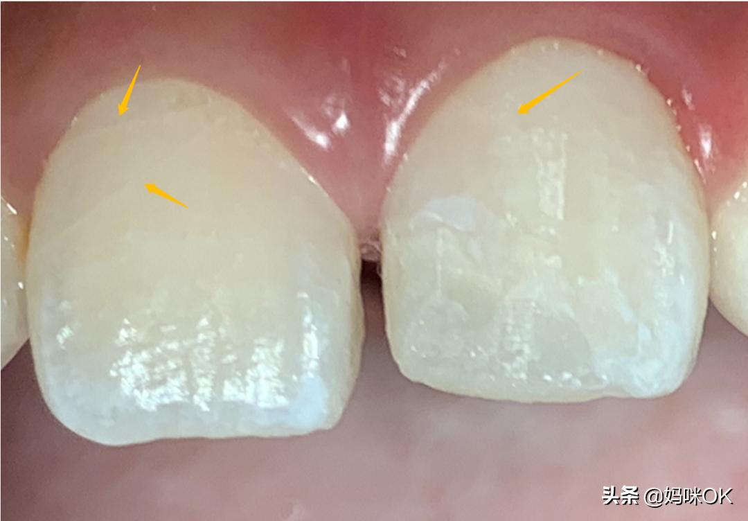 18岁前不能再用门牙吃东西！儿子的这一跤摔得有点惨痛