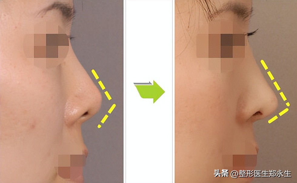 丑鼻子如何变成好看的鼻子,什么样的鼻子让人难看