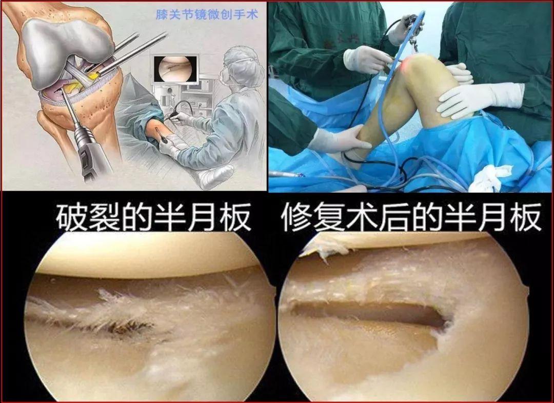磁共振显示半月板损伤2到3级,磁共振半月板损伤一定要做手术吗